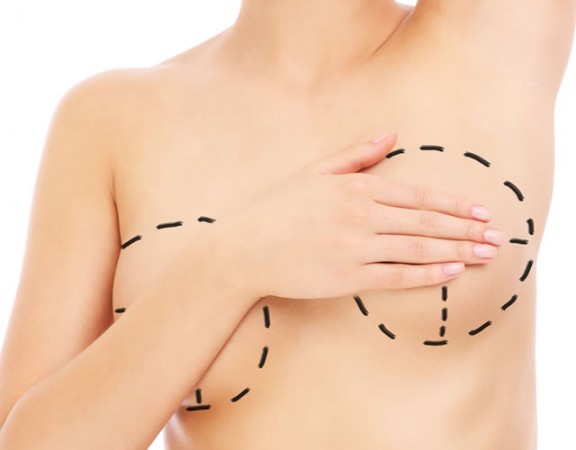 mamoplastia1