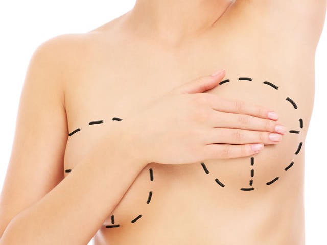 mamoplastia1